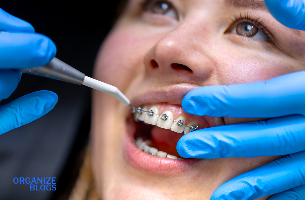 ceramic braces