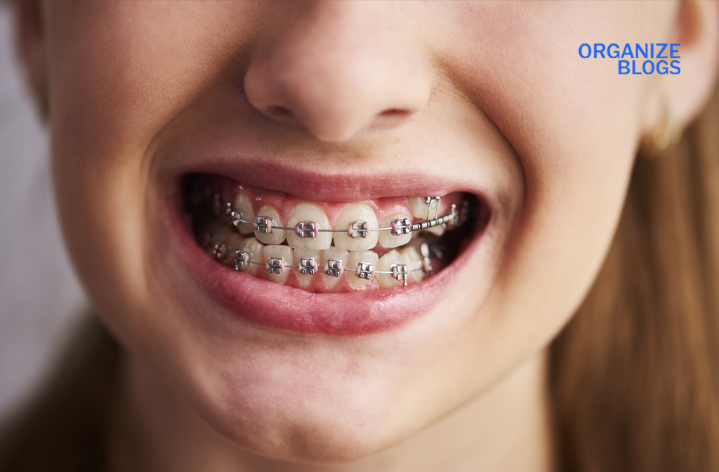 how much are braces